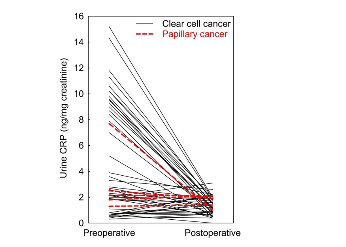 Figure 3. Pre- and post-surgery urine CRP concentrations
